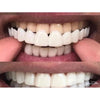 Carilla Dental Postiza Ajustable - SuperNova Shop