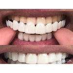 Carilla Dental Postiza Ajustable - SuperNova Shop
